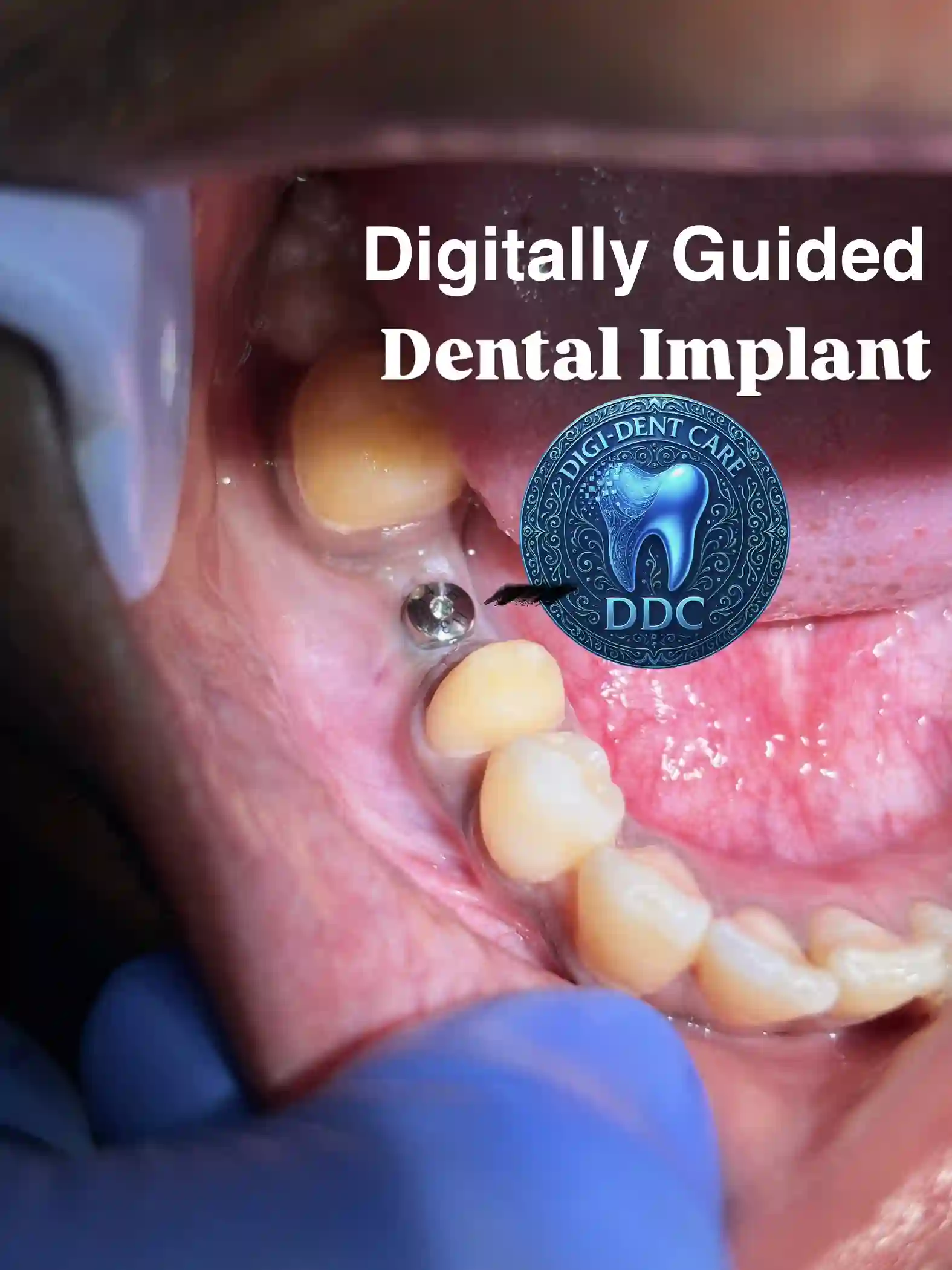 Digitally Guided Dental Implant